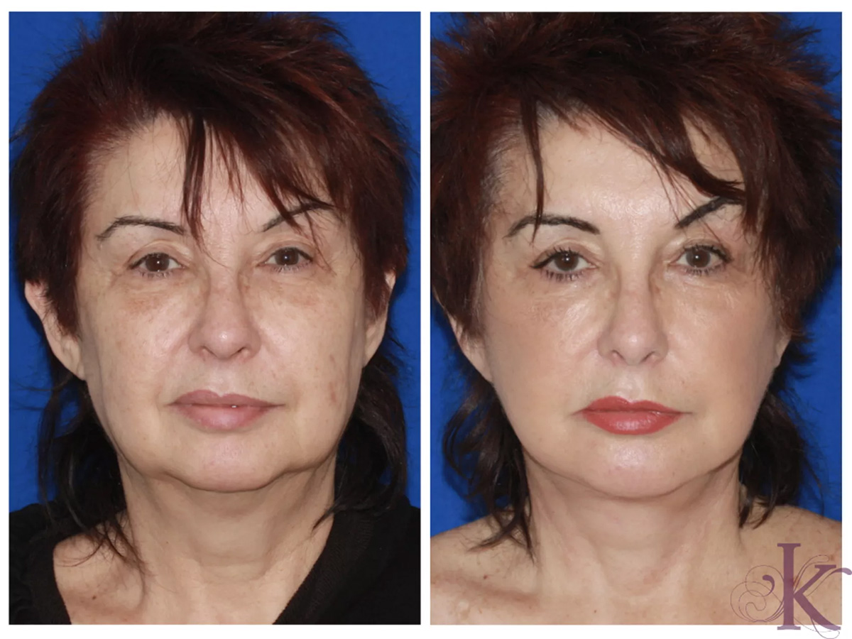 Before & After Facelift Case 105 View #1 View in NYC New York, NY