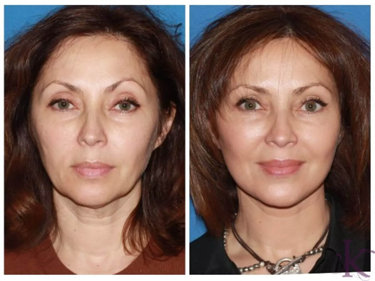 Before & After Facelift Case 11 View #1 View in NYC New York, NY