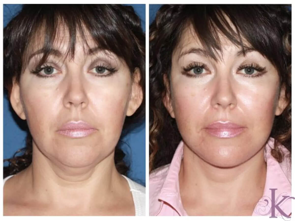 Before & After Facelift Case 12 View #1 View in NYC New York, NY