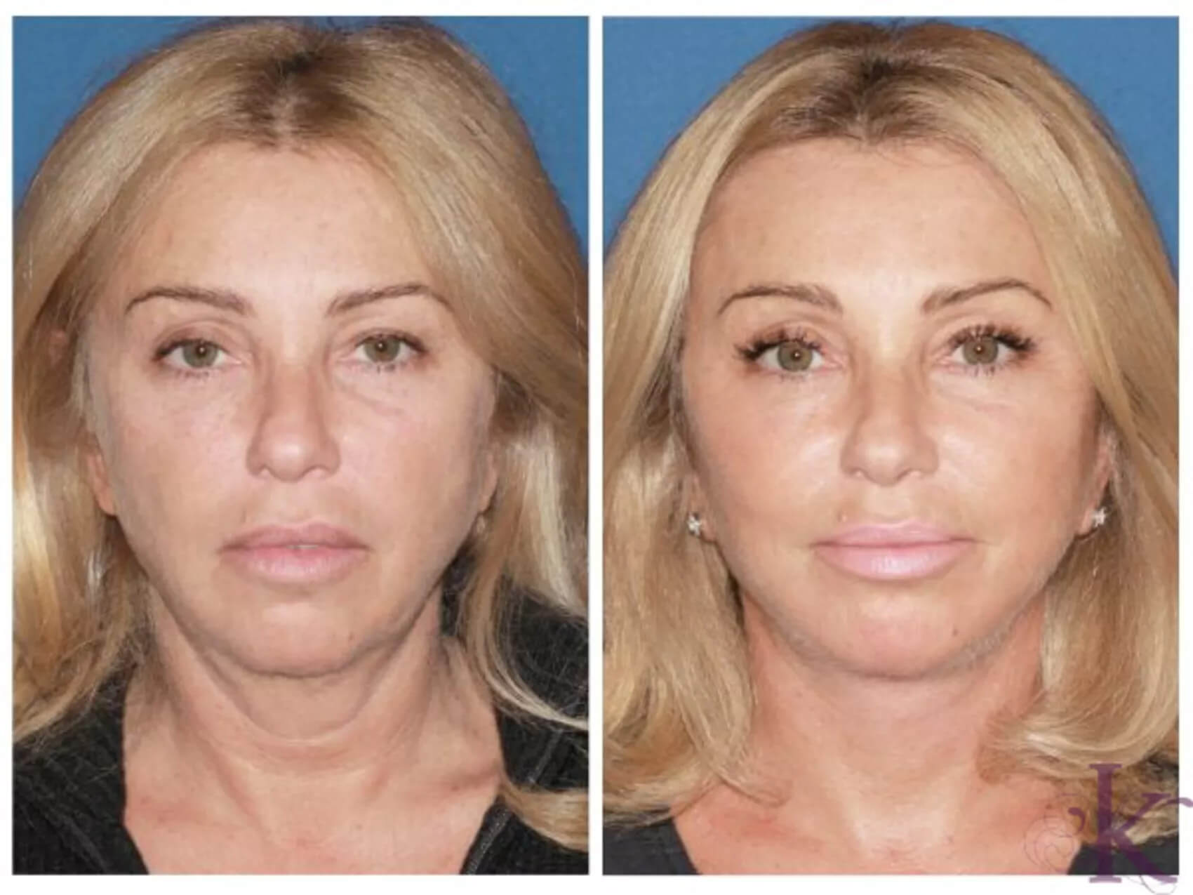 Before & After Facelift Case 27 View #1 View in NYC New York, NY