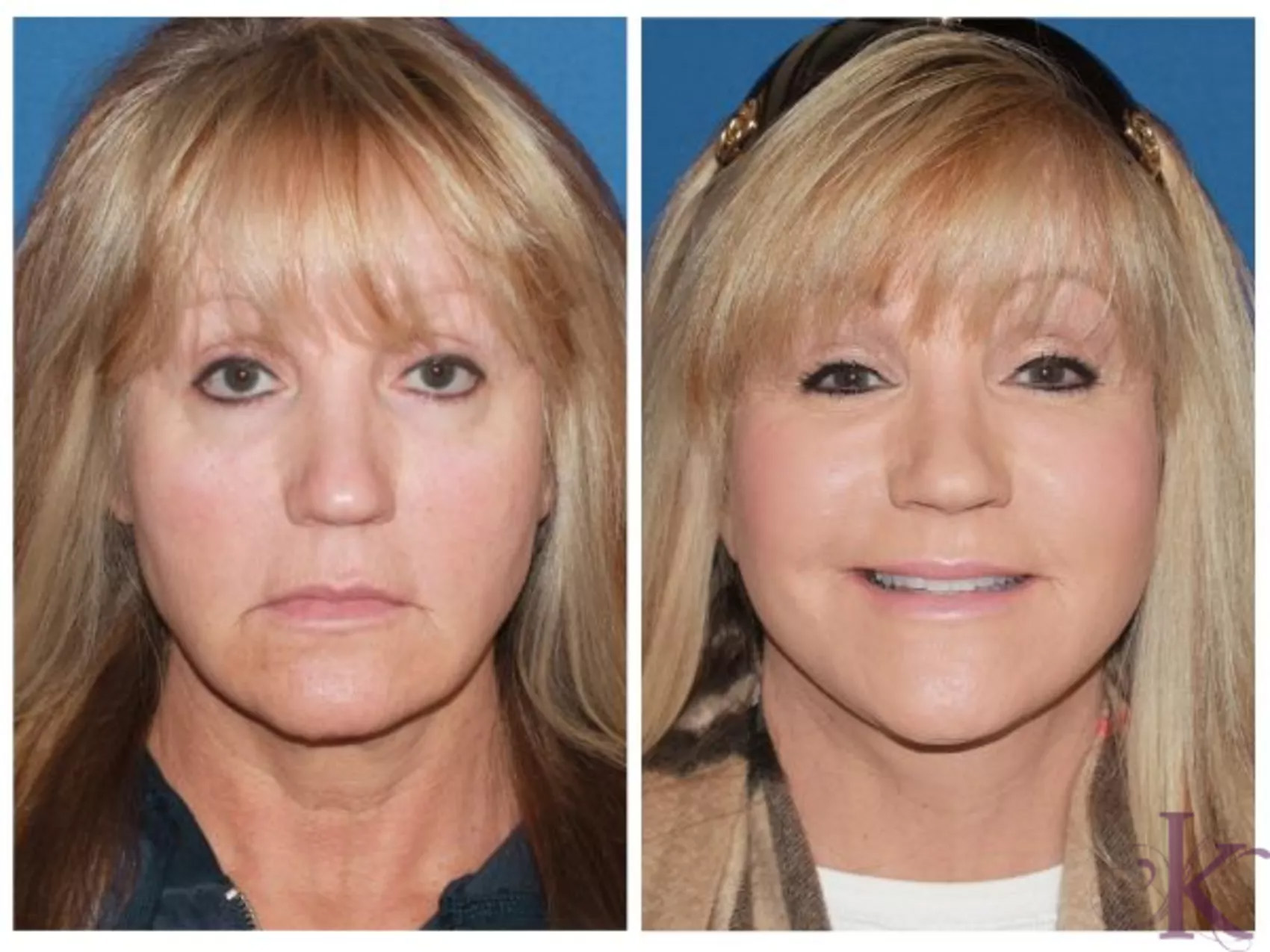 Before & After Facelift Case 30 View #1 View in NYC New York, NY