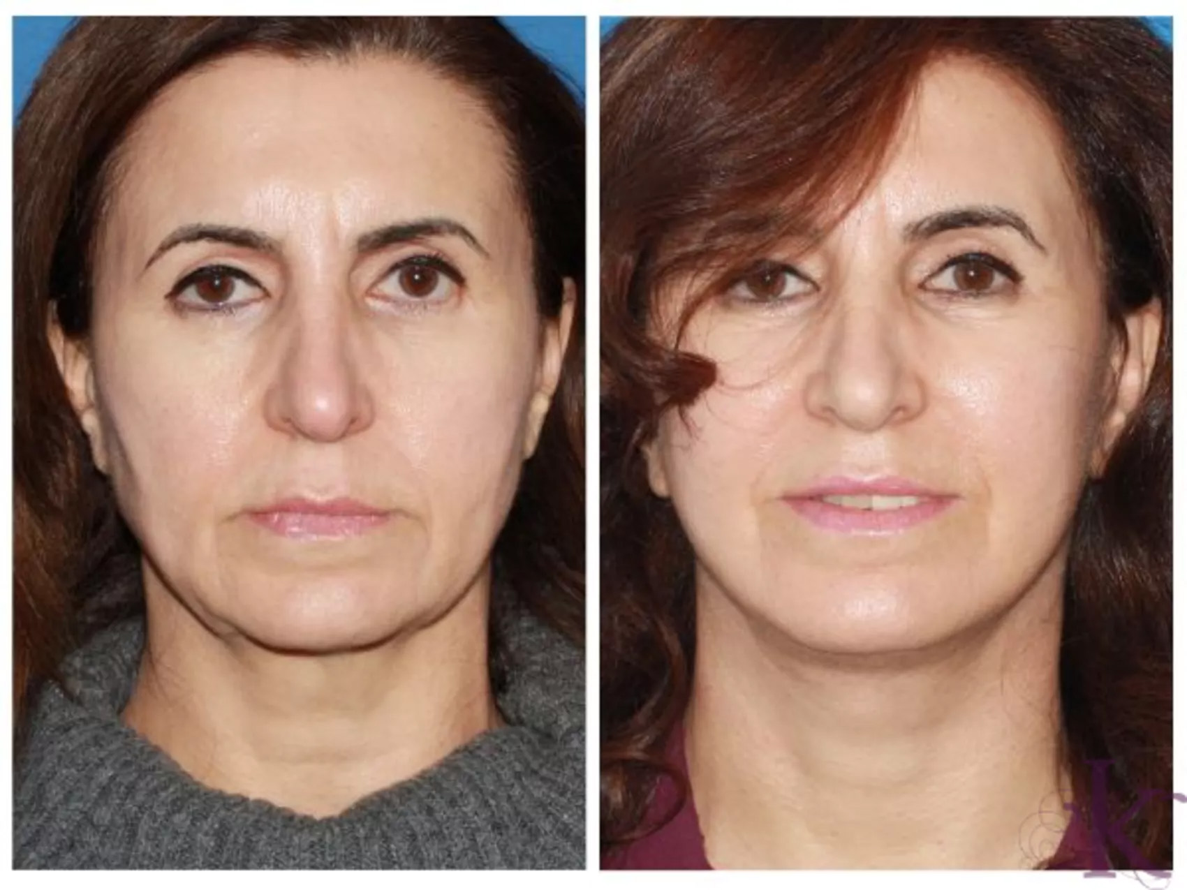 Before & After Facelift Case 45 View #1 View in NYC New York, NY