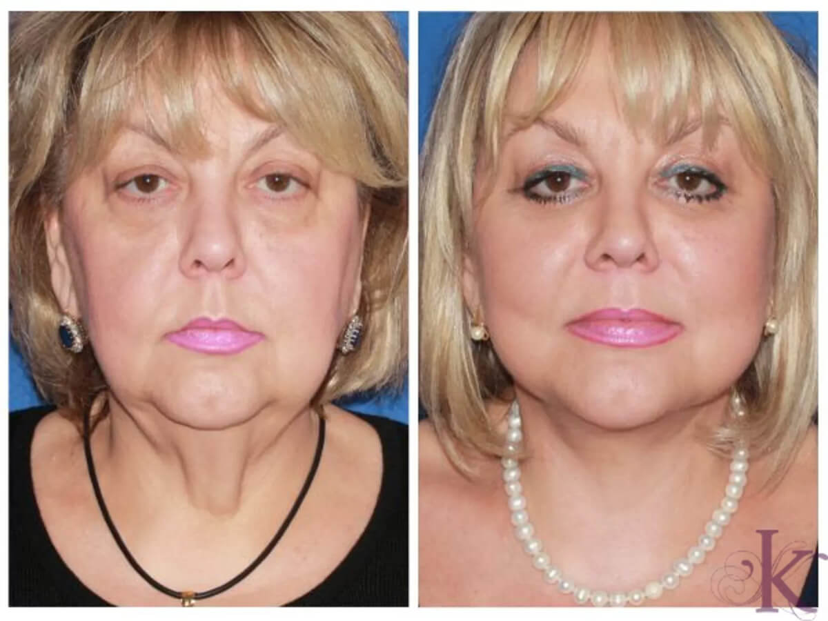 Before & After Facelift Case 46 View #1 View in NYC New York, NY