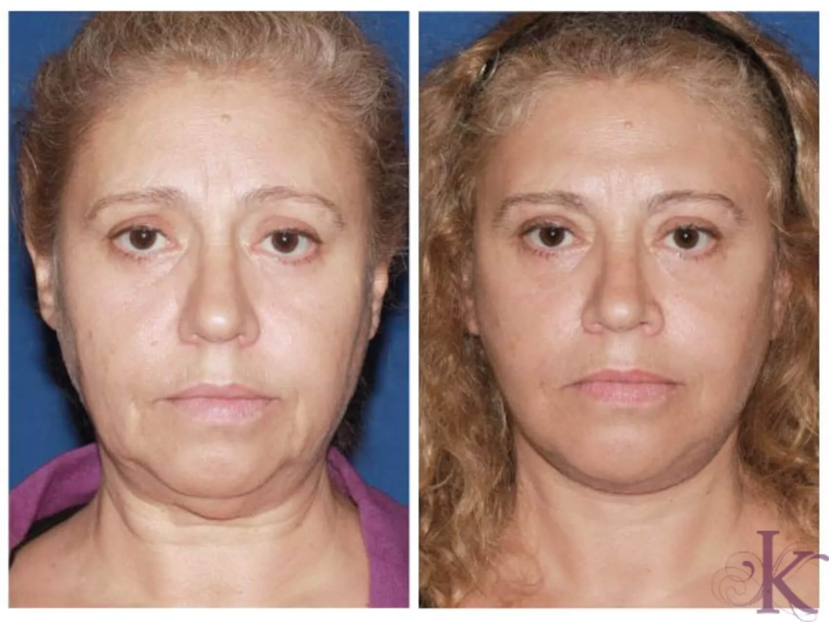 Before & After Facelift Case 50 View #1 View in NYC New York, NY