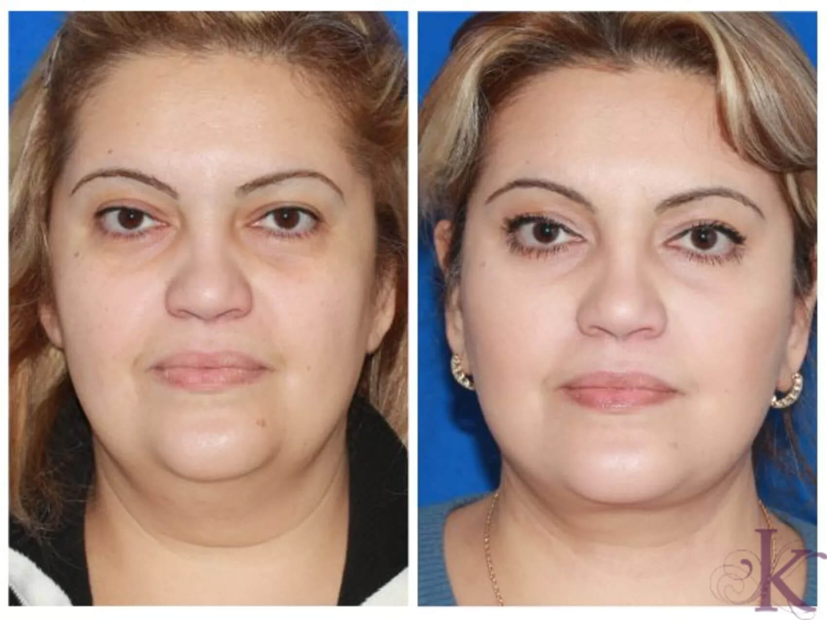 Before & After Facelift Case 51 View #1 View in NYC New York, NY