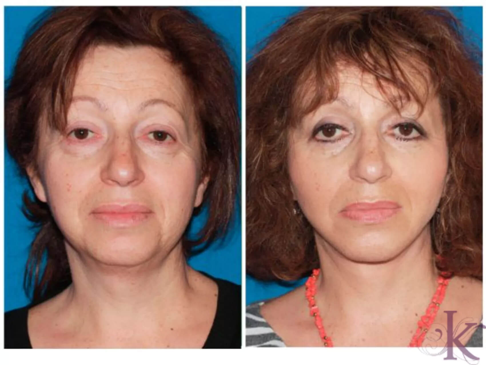 Before & After Facelift Case 54 View #1 View in NYC New York, NY