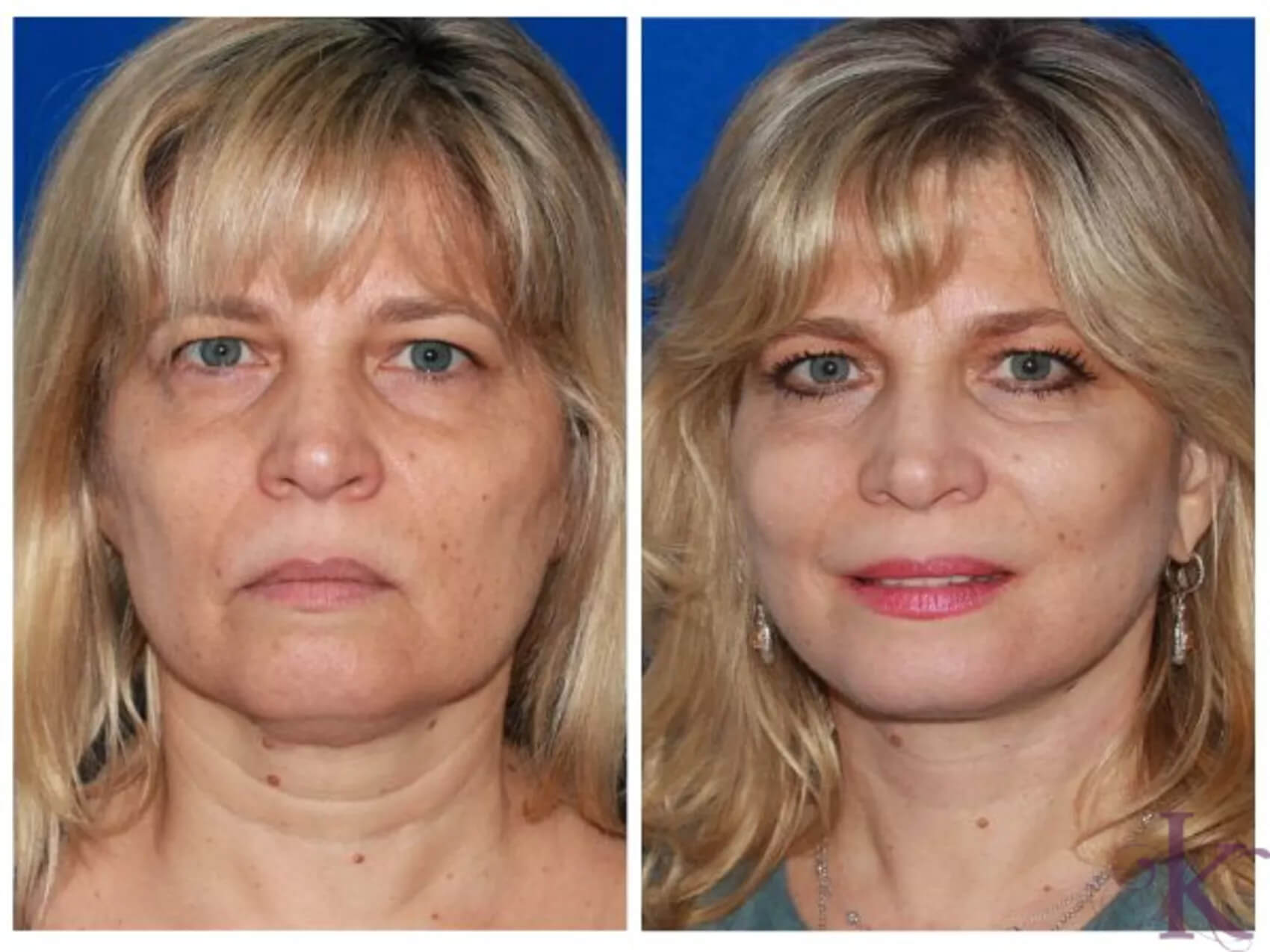 Before & After Facelift Case 65 View #1 View in NYC New York, NY