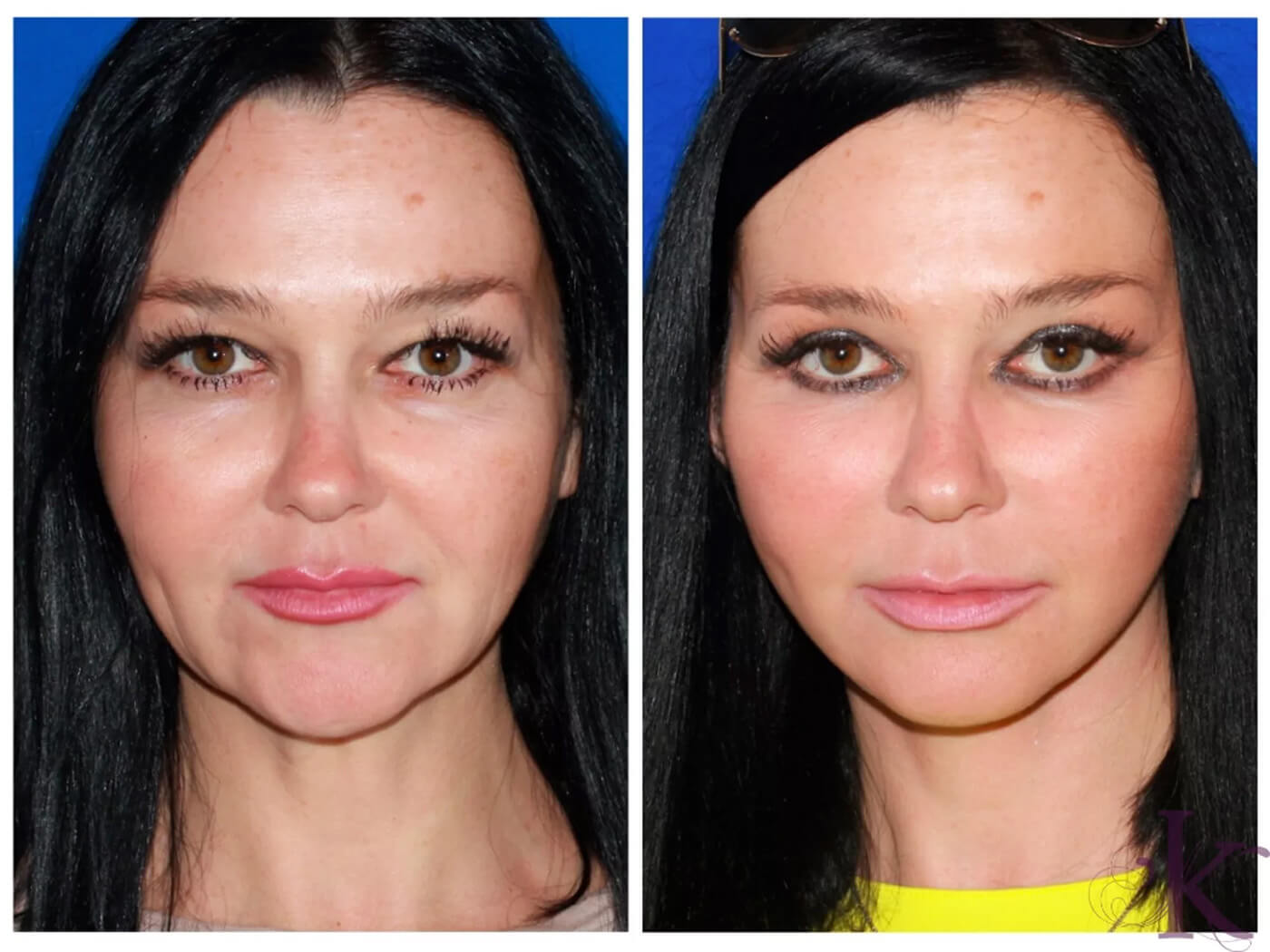 Before & After Facelift Case 78 View #1 View in NYC New York, NY