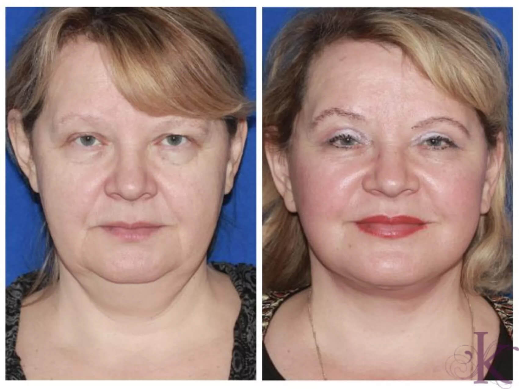 Before & After Facelift Case 79 View #1 View in NYC New York, NY