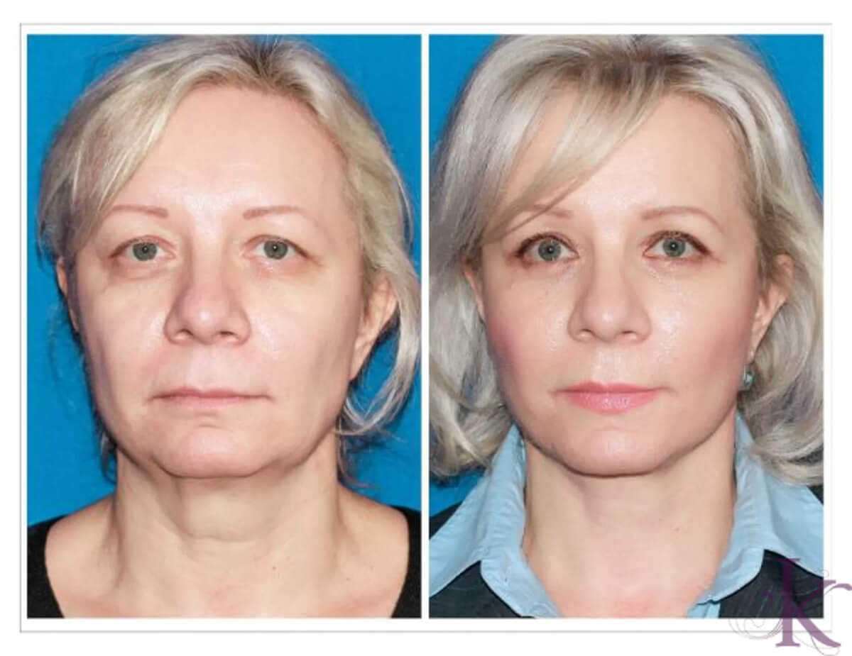 Before & After Facelift Case 8 View #1 View in NYC New York, NY