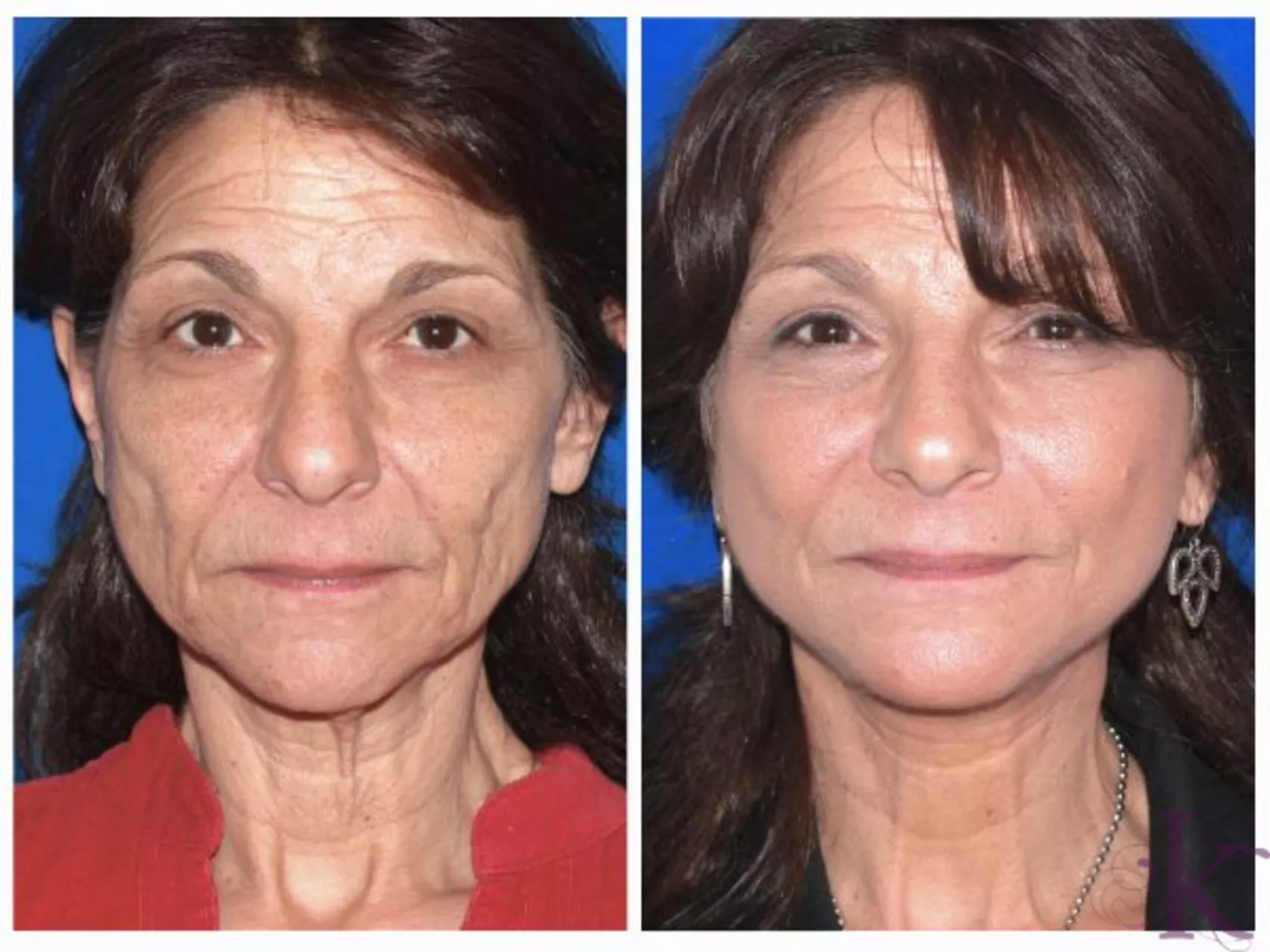 Before & After Facelift Case 81 View #1 View in NYC New York, NY