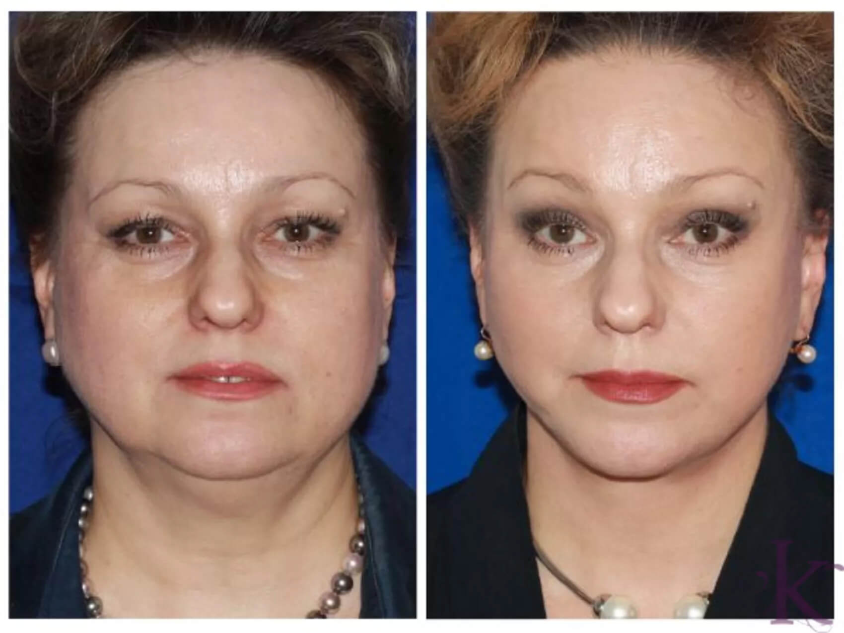 Before & After Facelift Case 82 View #1 View in NYC New York, NY