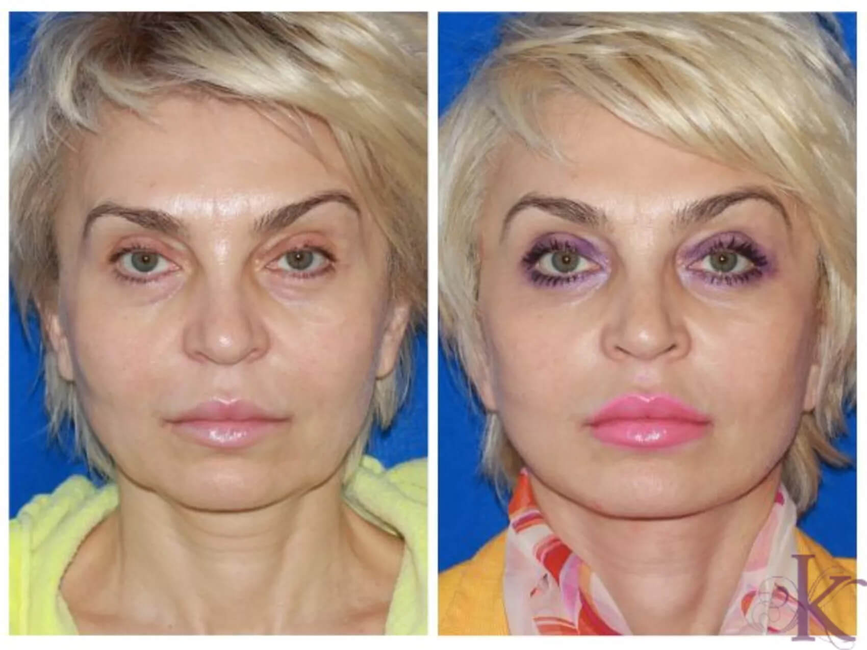 Before & After Facelift Case 83 View #1 View in NYC New York, NY