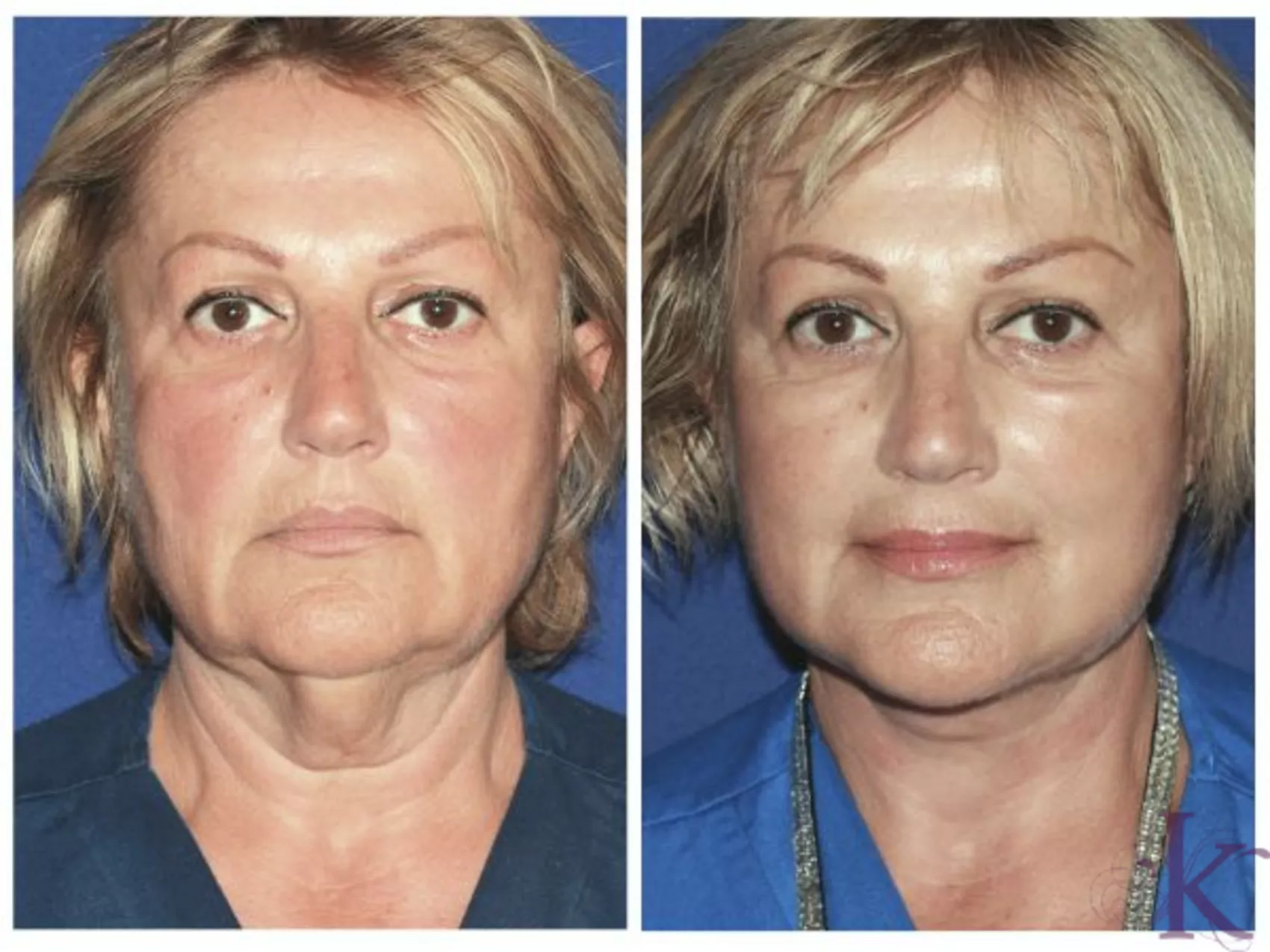 Before & After Facelift Case 85 View #1 View in NYC New York, NY