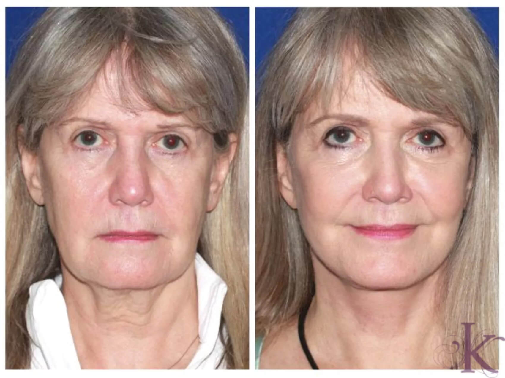 Before & After Facelift Case 87 View #1 View in NYC New York, NY