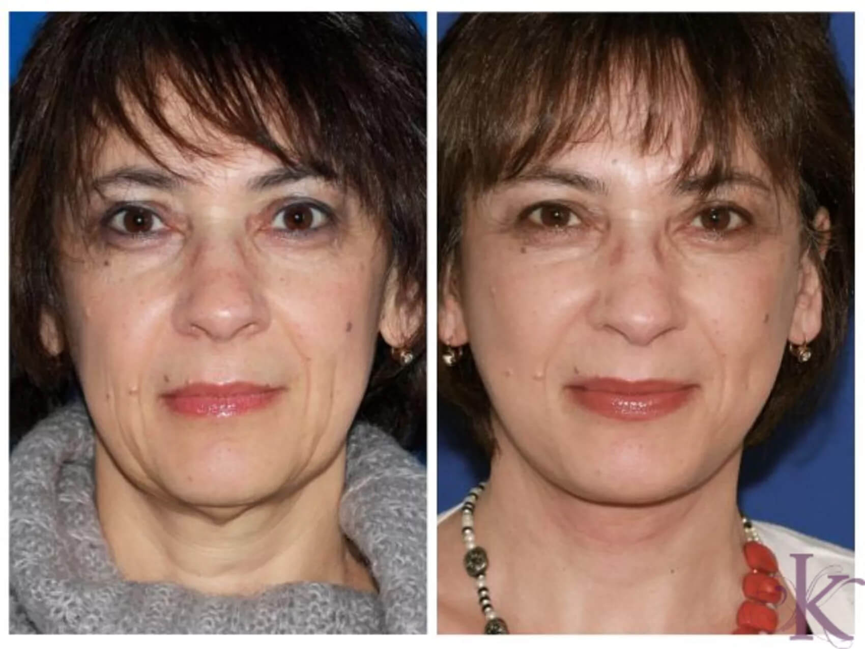 Before & After Facelift Case 88 View #1 View in NYC New York, NY