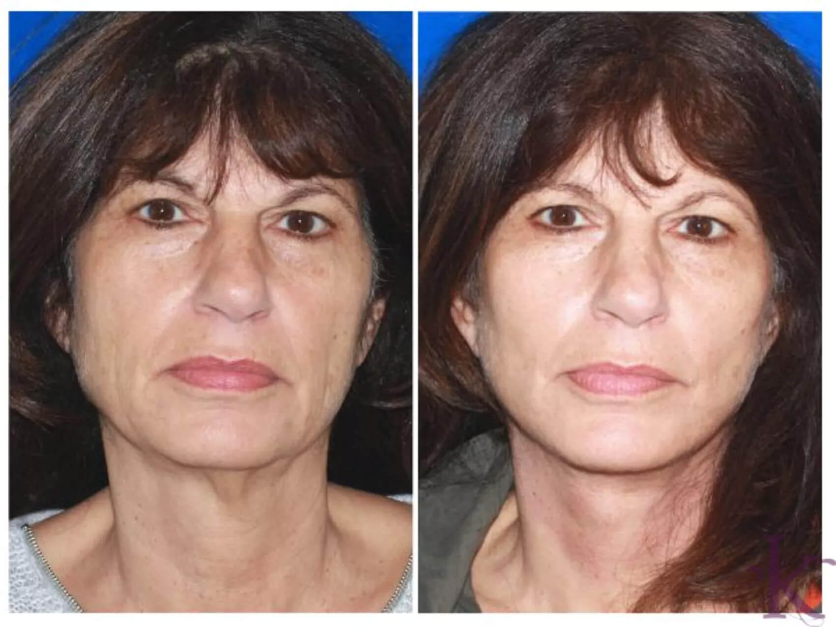 Before & After Facelift Case 89 View #1 View in NYC New York, NY