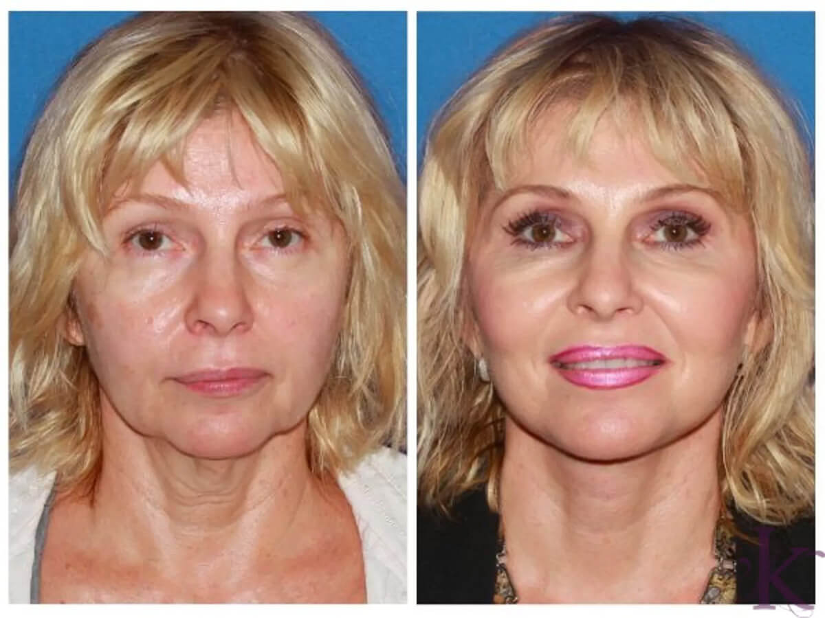 Before & After Facelift Case 9 View #1 View in NYC New York, NY