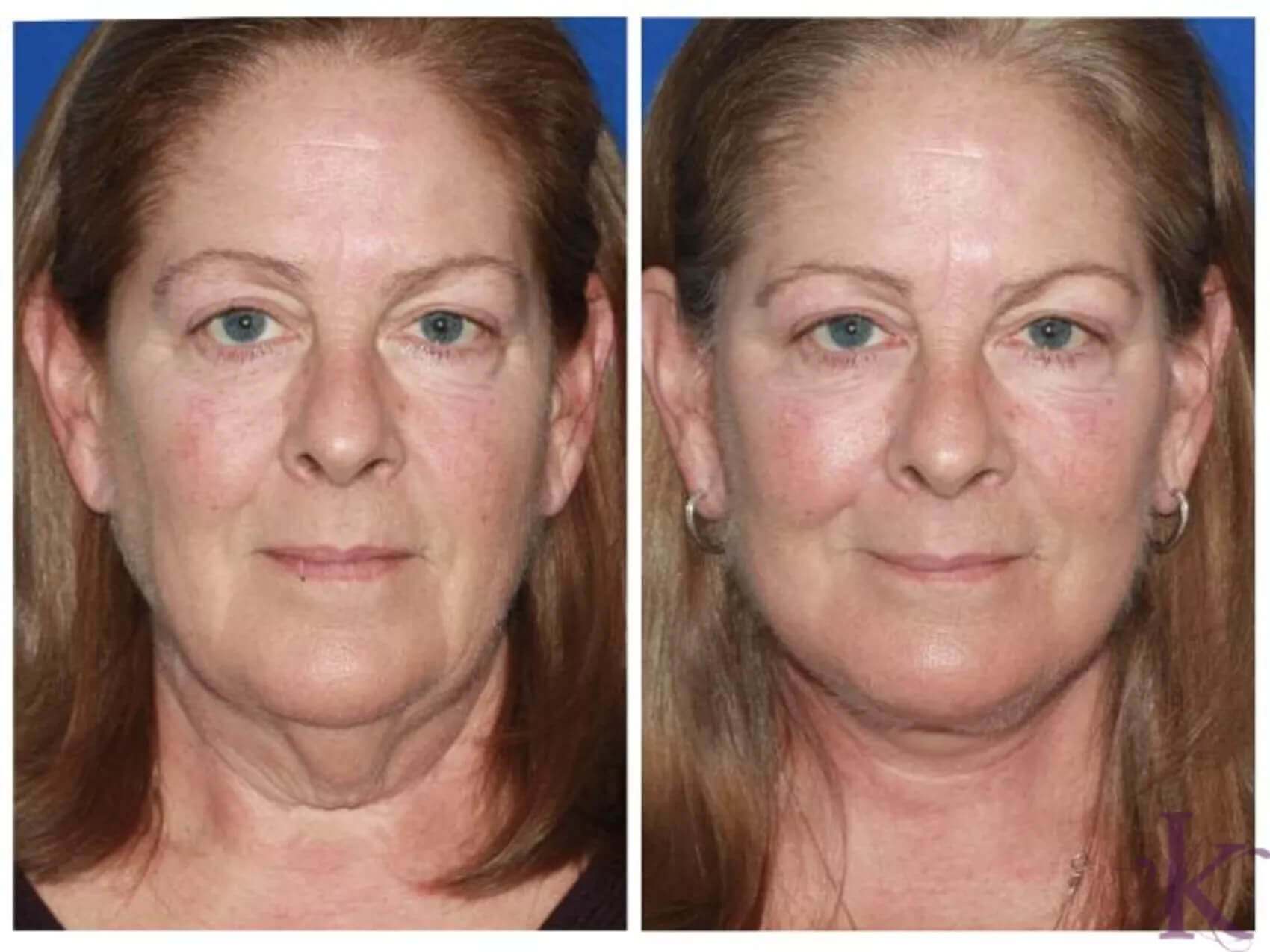 Before & After Facelift Case 92 View #1 View in NYC New York, NY