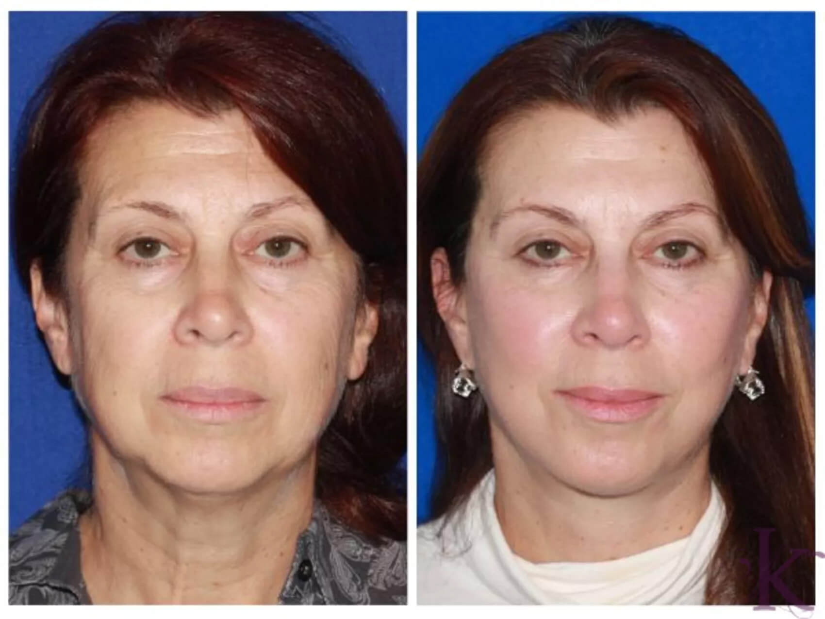 Before & After Facelift Case 93 View #1 View in NYC New York, NY