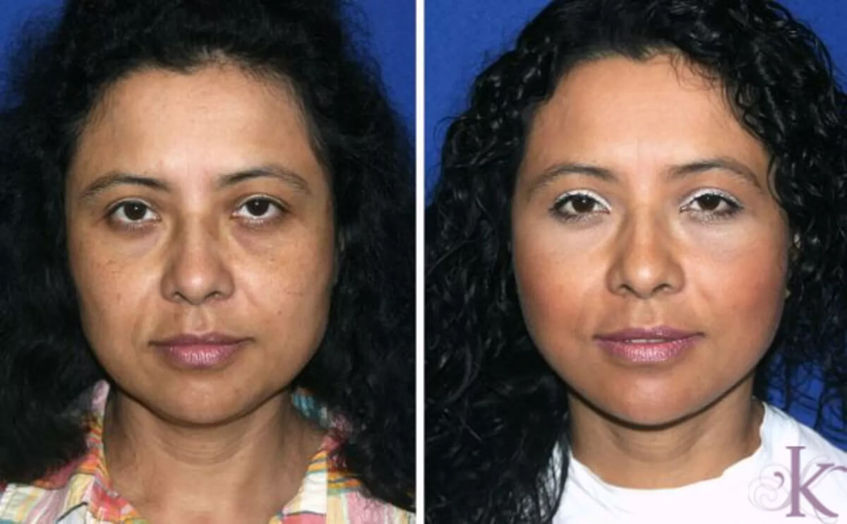 Before & After Facelift Case 94 View #1 View in NYC New York, NY