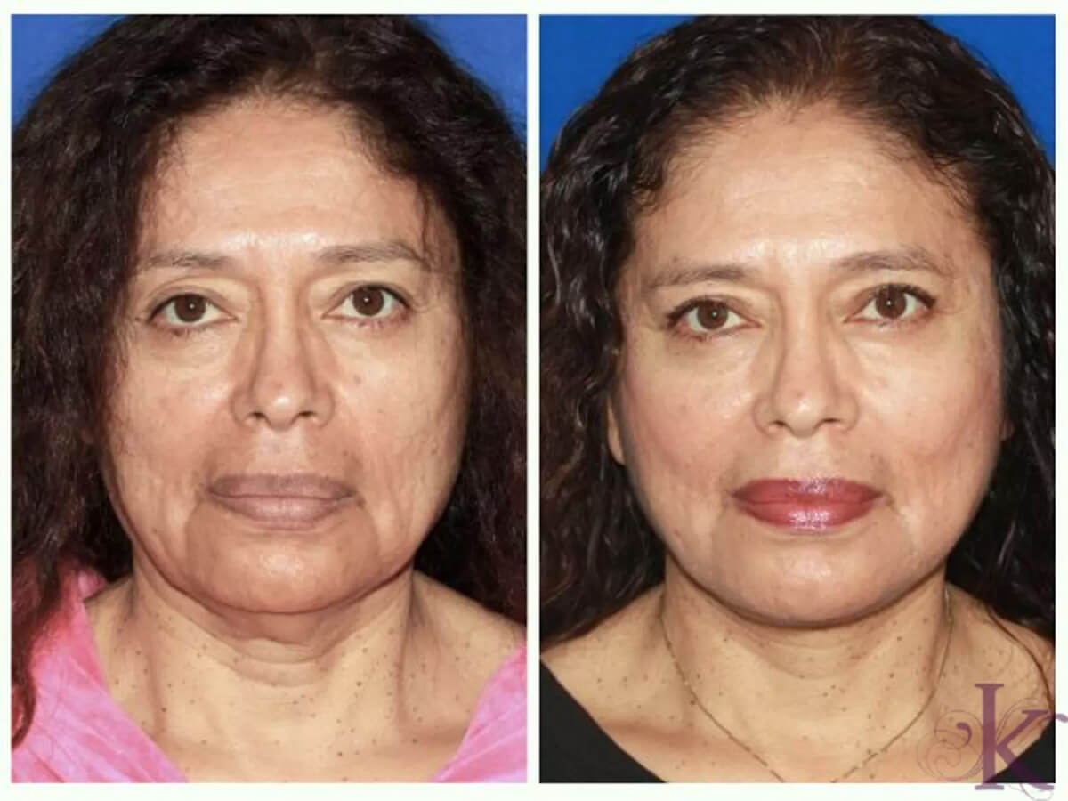 Before & After Facelift Case 96 View #1 View in NYC New York, NY