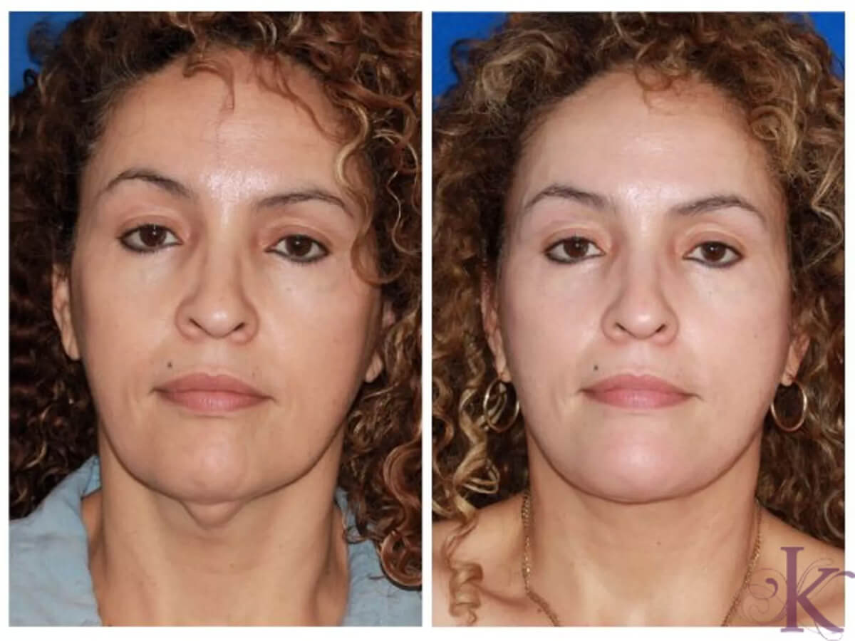 Before & After Facelift Case 97 View #1 View in NYC New York, NY