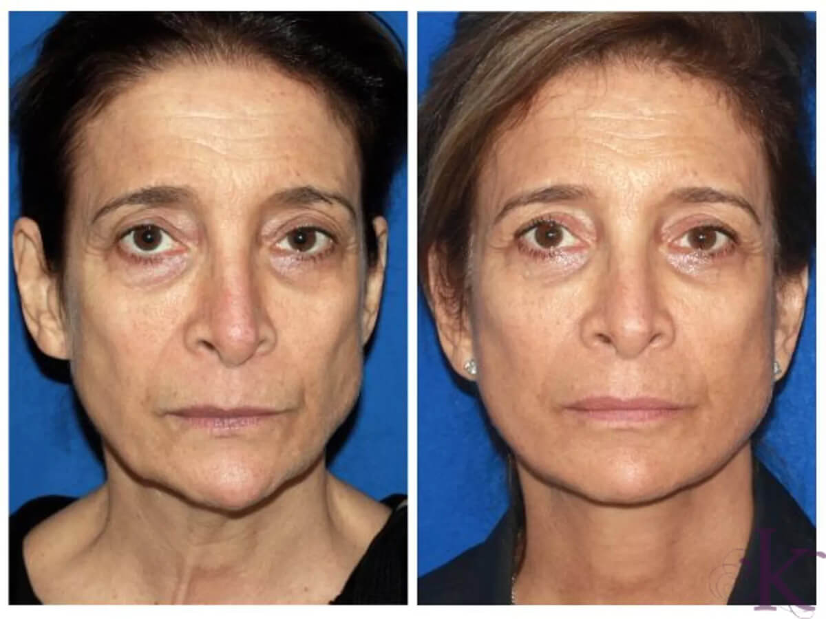 Before & After Facelift Case 98 View #1 View in NYC New York, NY