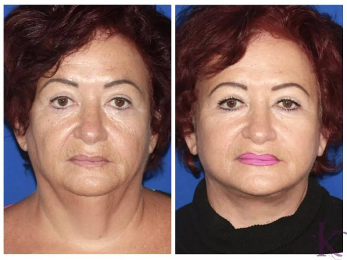 Before & After Facelift Case 99 View #1 View in NYC New York, NY