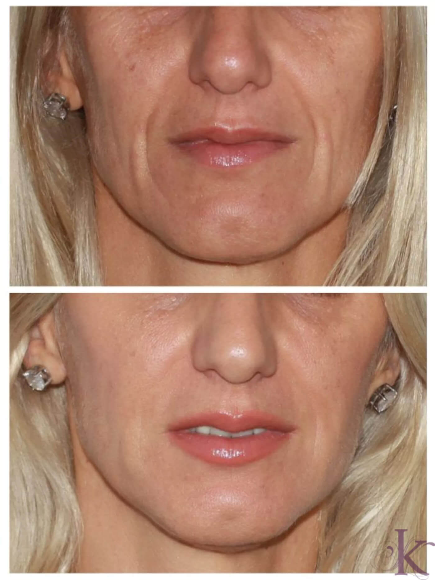 Before & After Fillers & Fat Grafting Case 101 View #1 View in NYC New York, NY