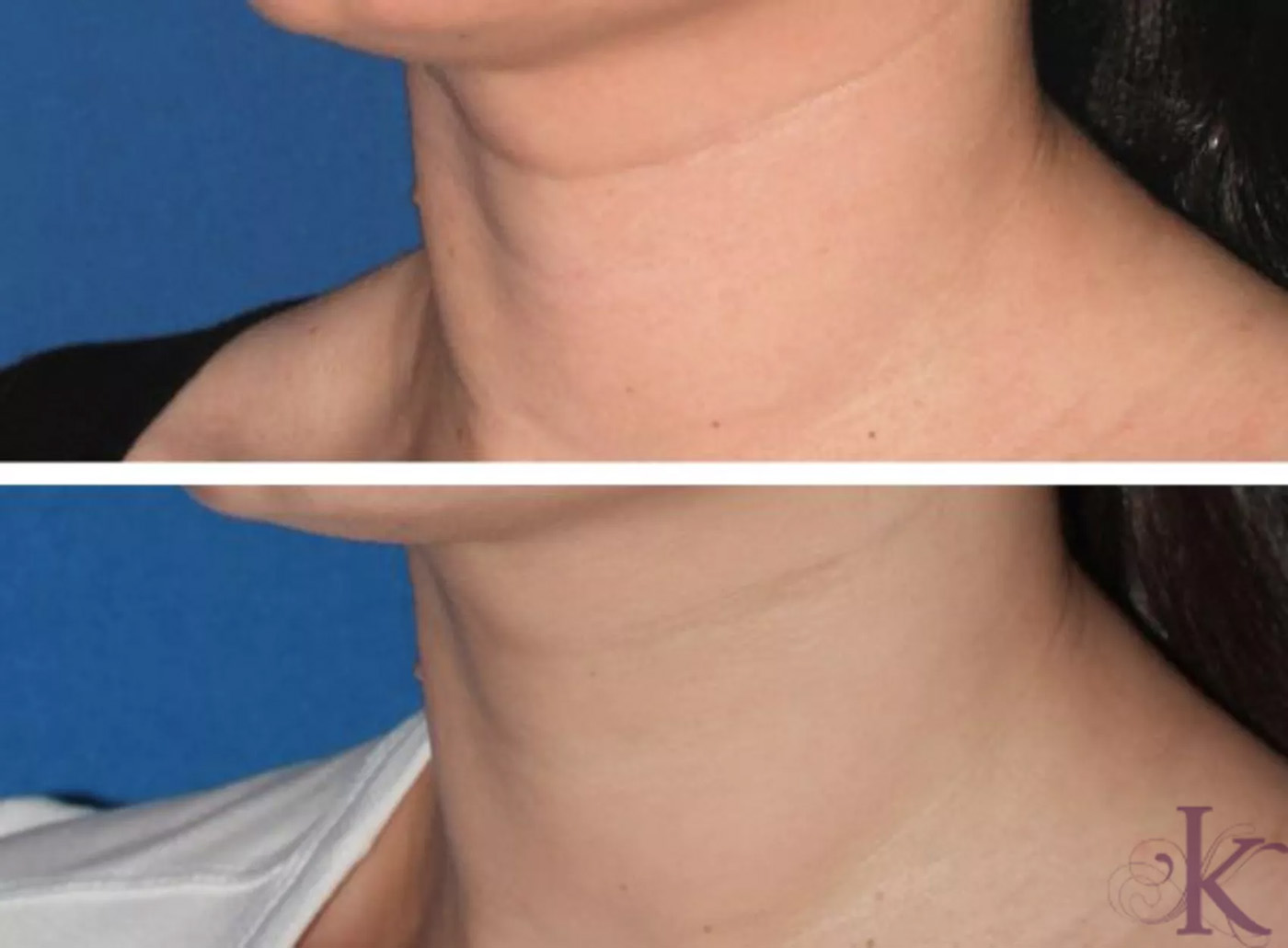 Before & After Fillers & Fat Grafting Case 35 View #1 View in NYC New York, NY