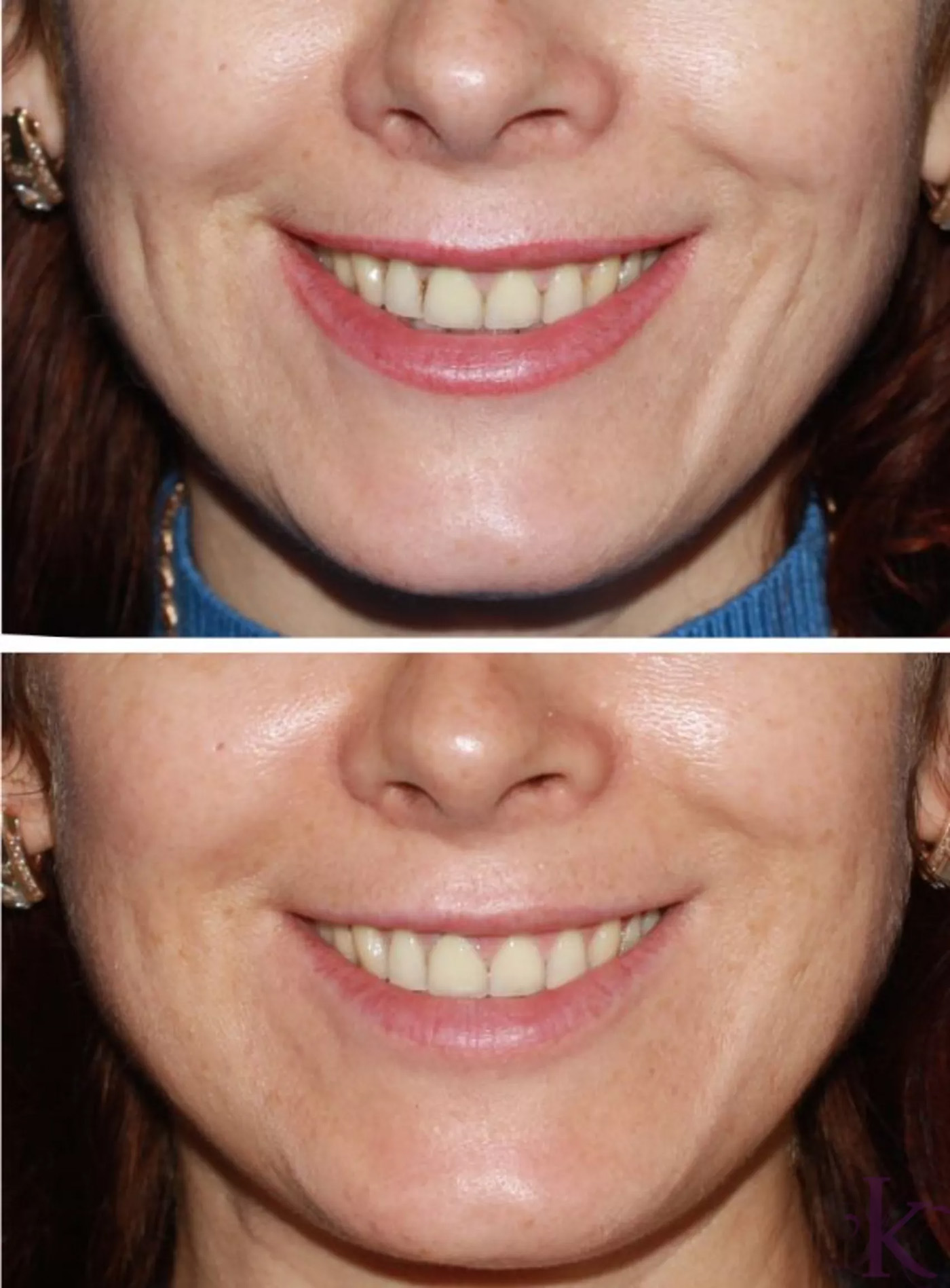 Before & After Fillers & Fat Grafting Case 38 View #1 View in NYC New York, NY