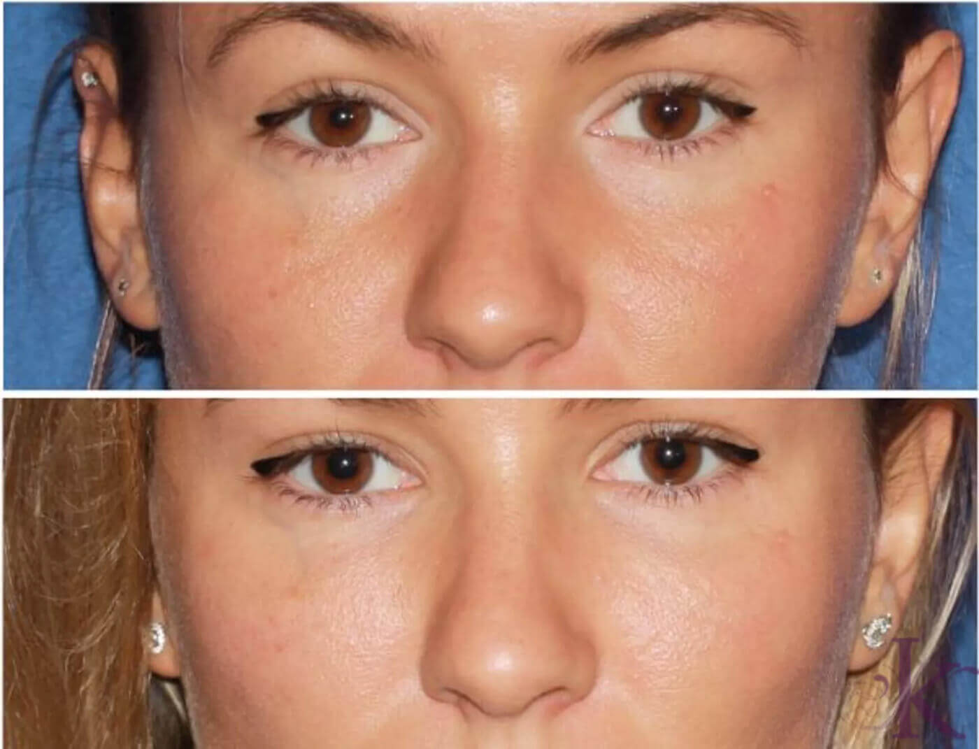 Before & After Fillers & Fat Grafting Case 39 View #1 View in NYC New York, NY