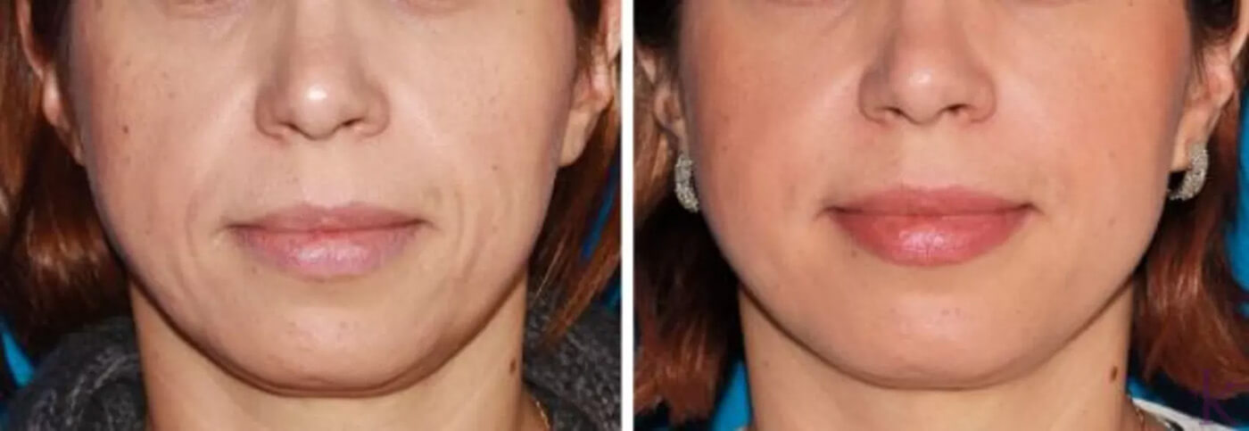 Before & After Fillers & Fat Grafting Case 55 View #1 View in NYC New York, NY