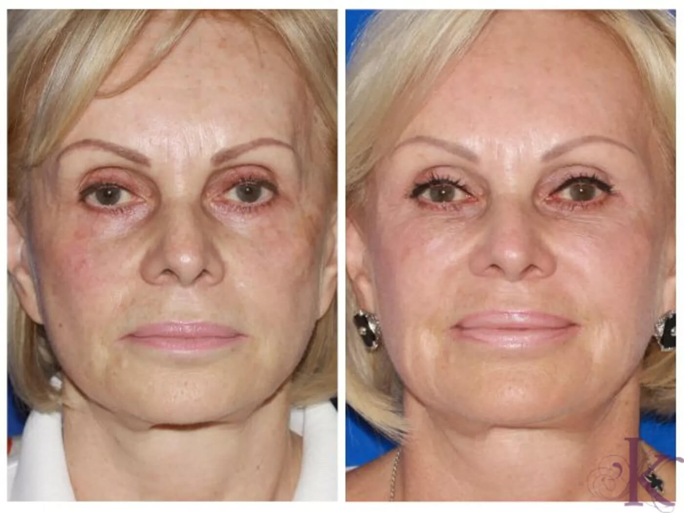 Before & After Fillers & Fat Grafting Case 63 View #1 View in NYC New York, NY