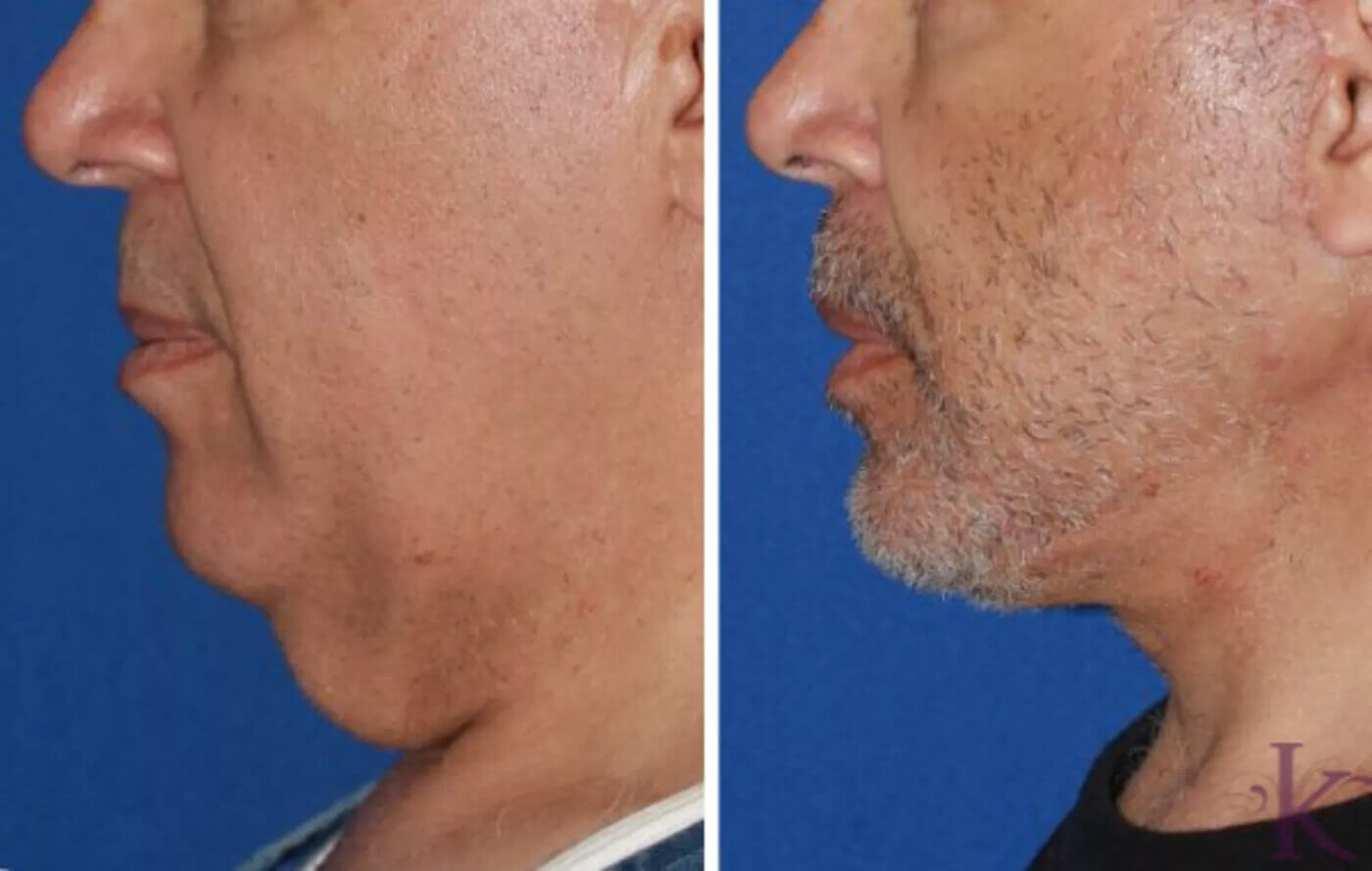 Before & After Male Face & Neck Lift Case 59 View #1 View in NYC New York, NY