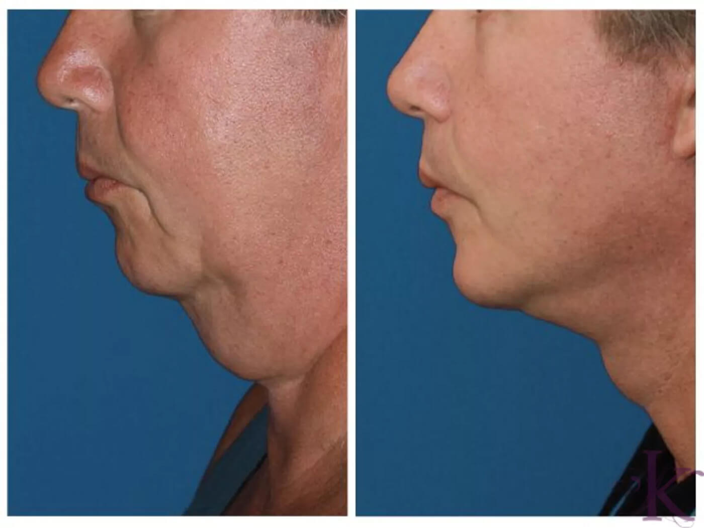 Before & After Male Face & Neck Lift Case 61 View #1 View in NYC New York, NY
