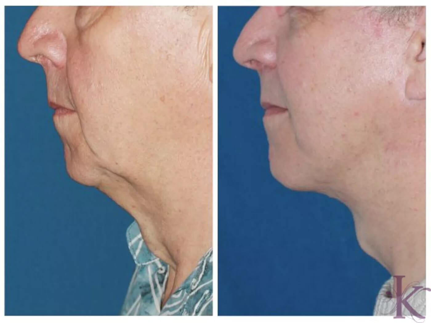 Before & After Male Face & Neck Lift Case 62 View #1 View in NYC New York, NY