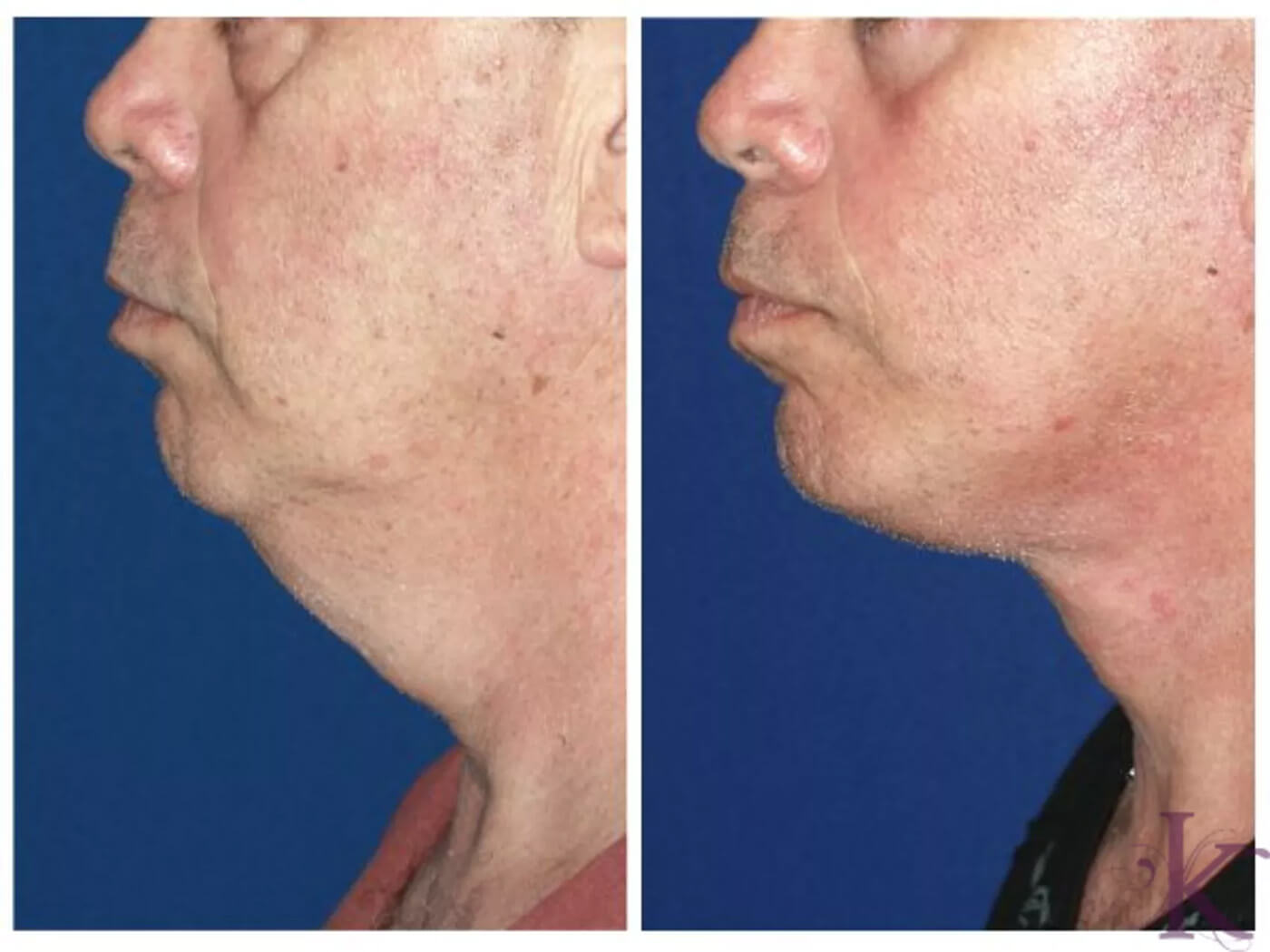 Before & After Male Face & Neck Lift Case 67 View #1 View in NYC New York, NY