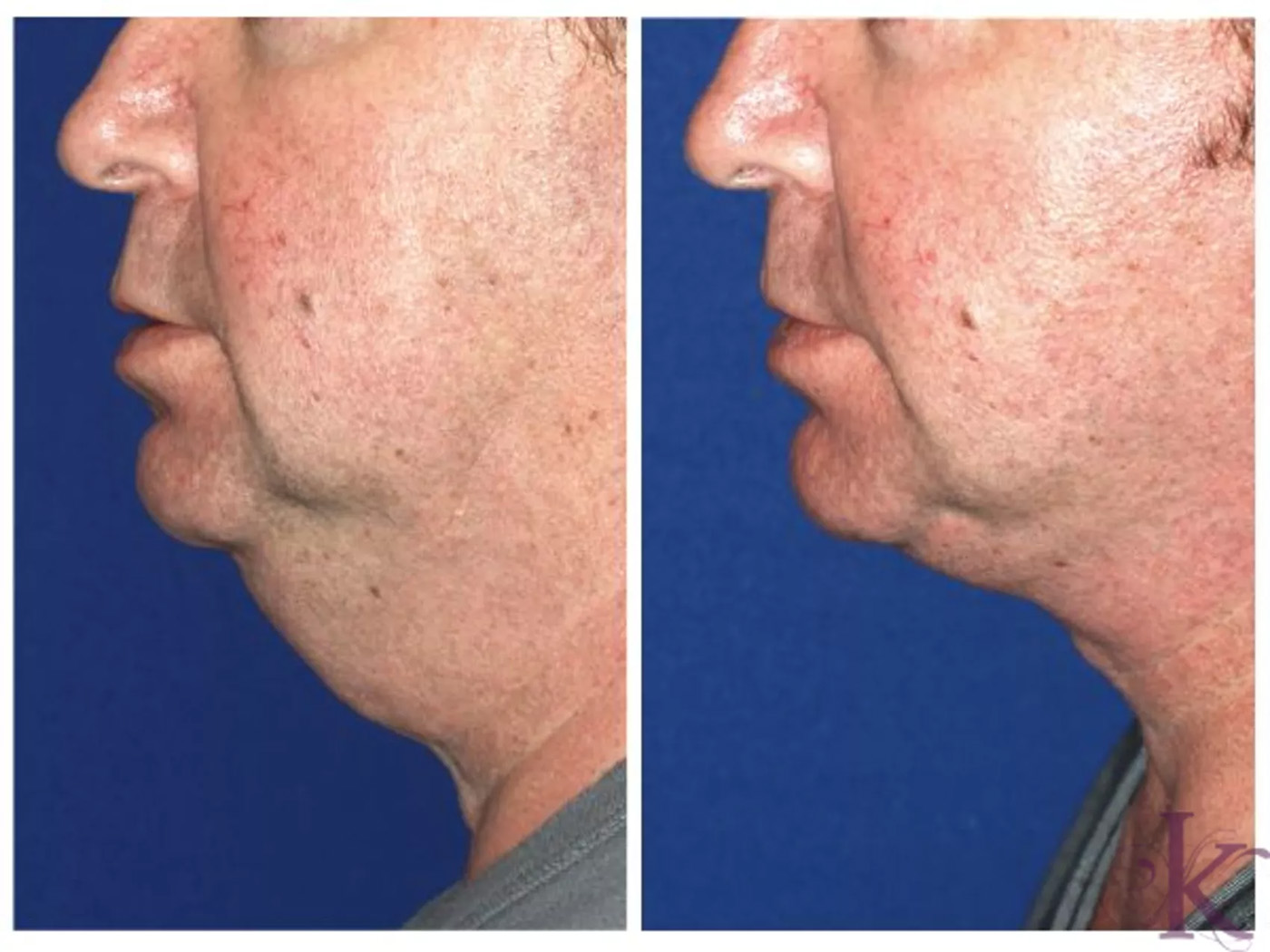 Before & After Male Face & Neck Lift Case 68 View #1 View in NYC New York, NY