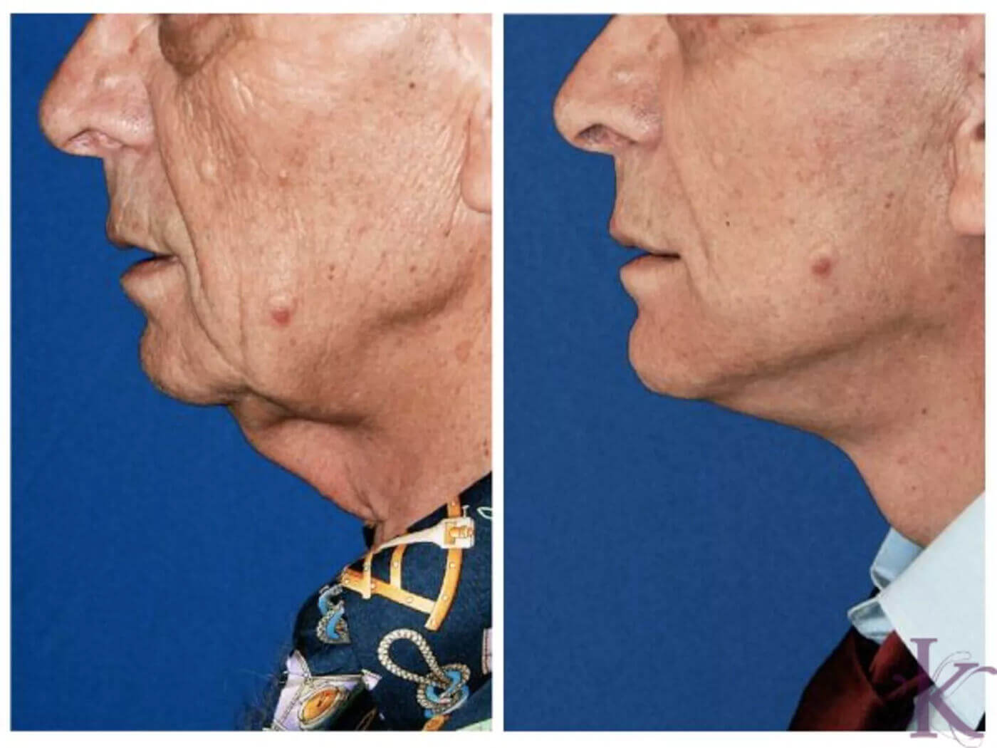 Before & After Male Face & Neck Lift Case 69 View #1 View in NYC New York, NY