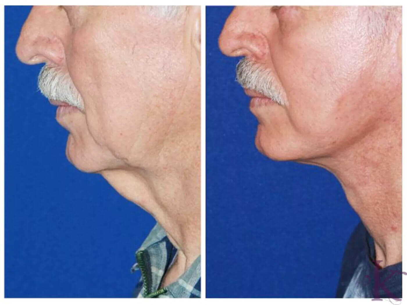 Before & After Male Face & Neck Lift Case 70 View #1 View in NYC New York, NY