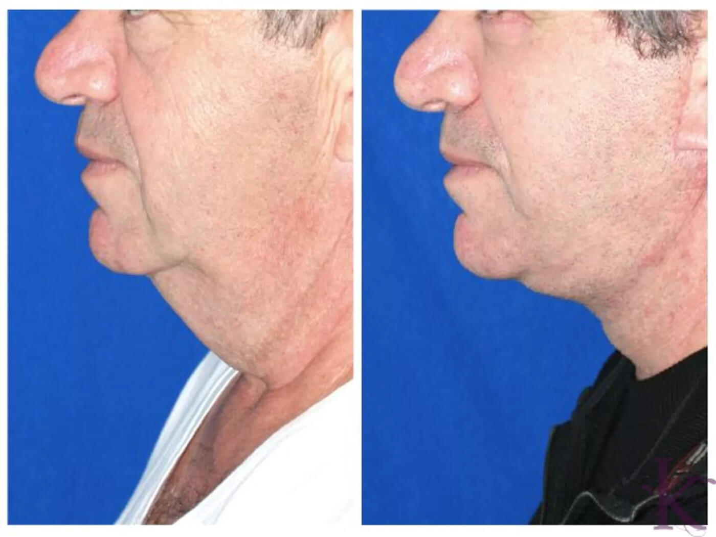 Before & After Male Face & Neck Lift Case 74 View #1 View in NYC New York, NY