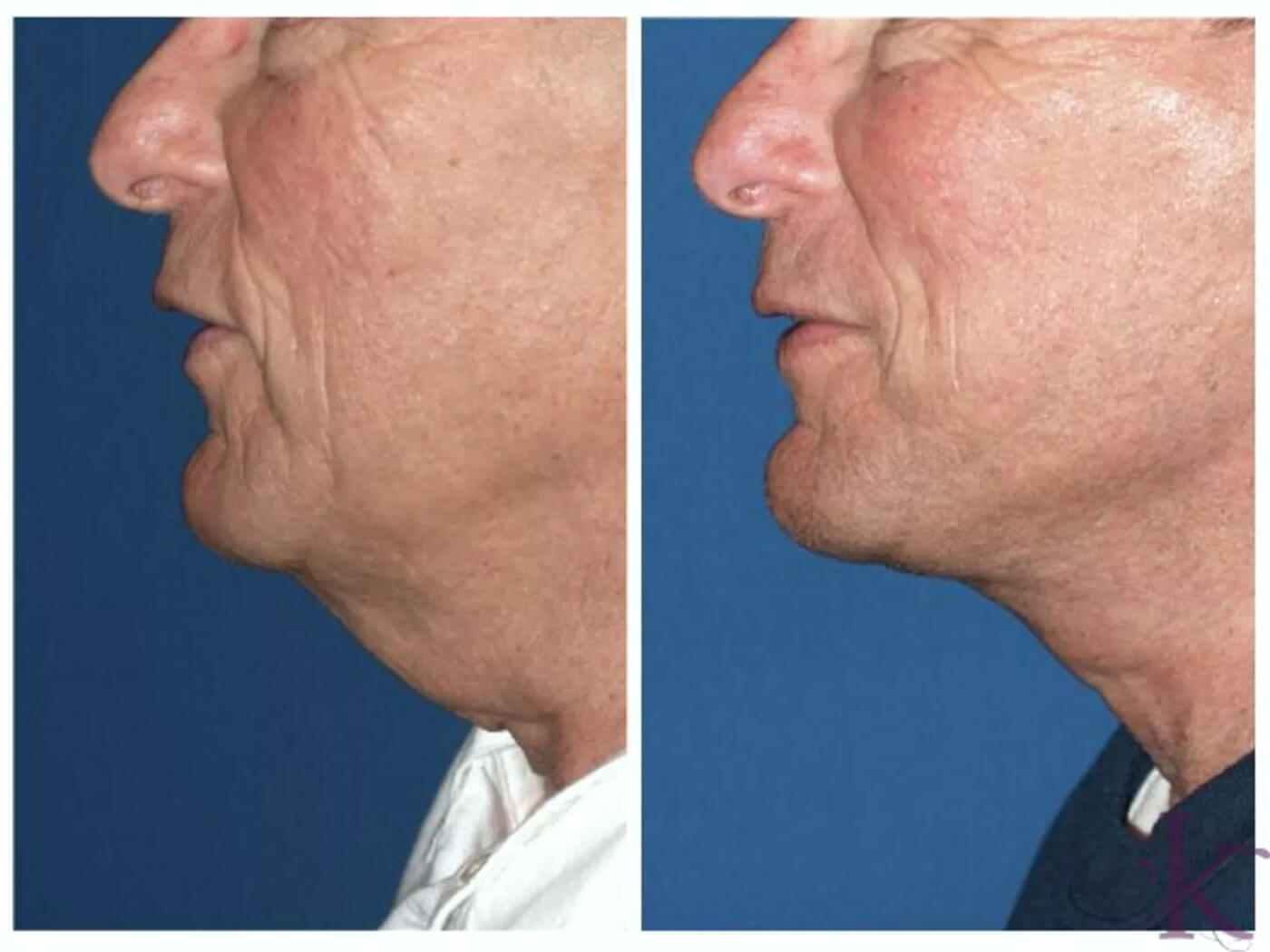 Before & After Male Face & Neck Lift Case 76 View #1 View in NYC New York, NY