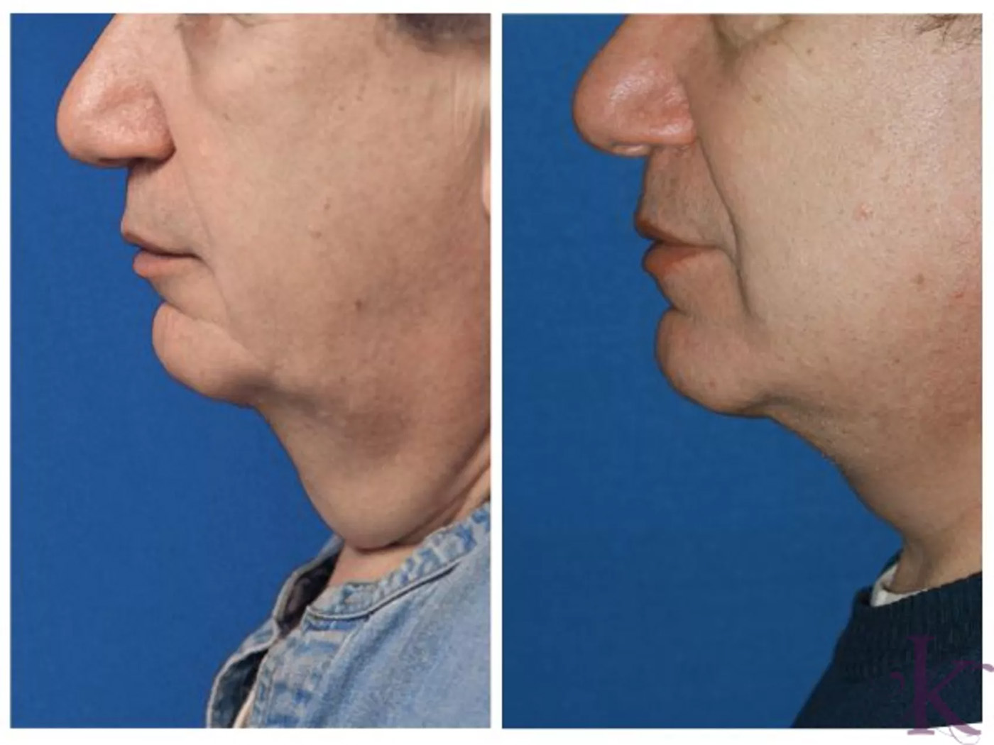 Before & After Male Face & Neck Lift Case 77 View #1 View in NYC New York, NY