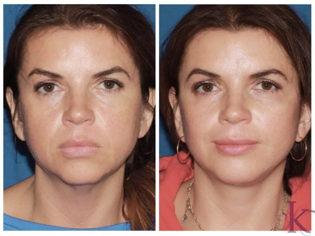 Before & After Mini Facelift Case 28 View #1 View in NYC New York, NY
