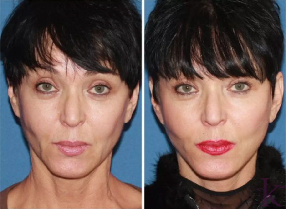 Before & After Mini Facelift Case 29 View #1 View in NYC New York, NY
