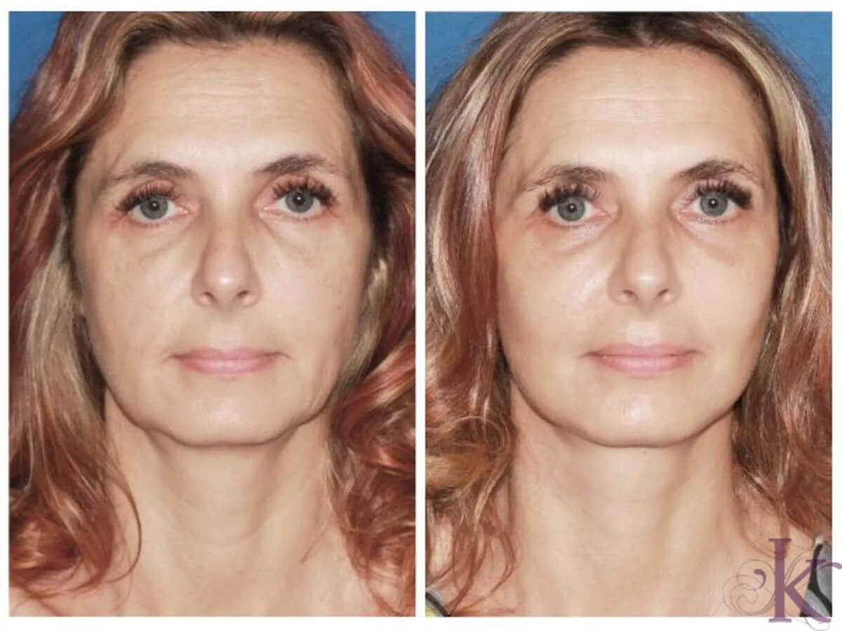 Before & After Mini Facelift Case 57 View #1 View in NYC New York, NY