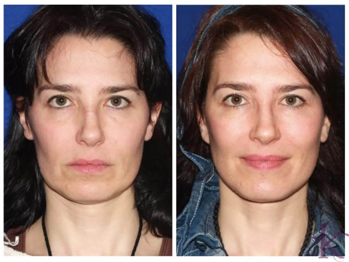 Before & After Mini Facelift Case 90 View #1 View in NYC New York, NY