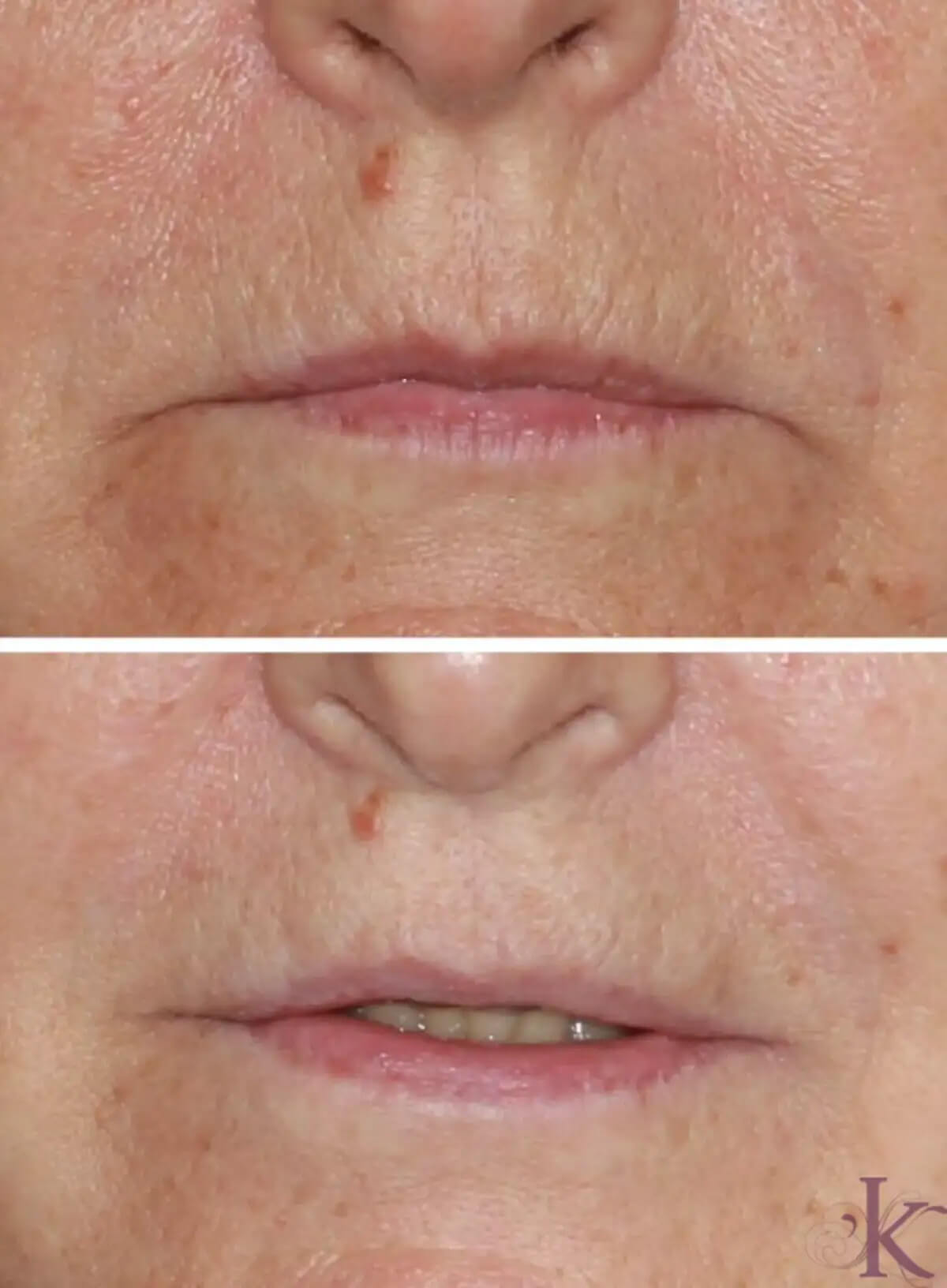 Before & After Skin Resurfacing Case 34 View #1 View in NYC New York, NY